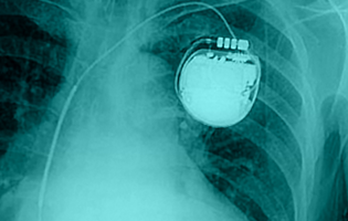 ZNA Hartcentrum reageert op nieuws rond pacemakers
